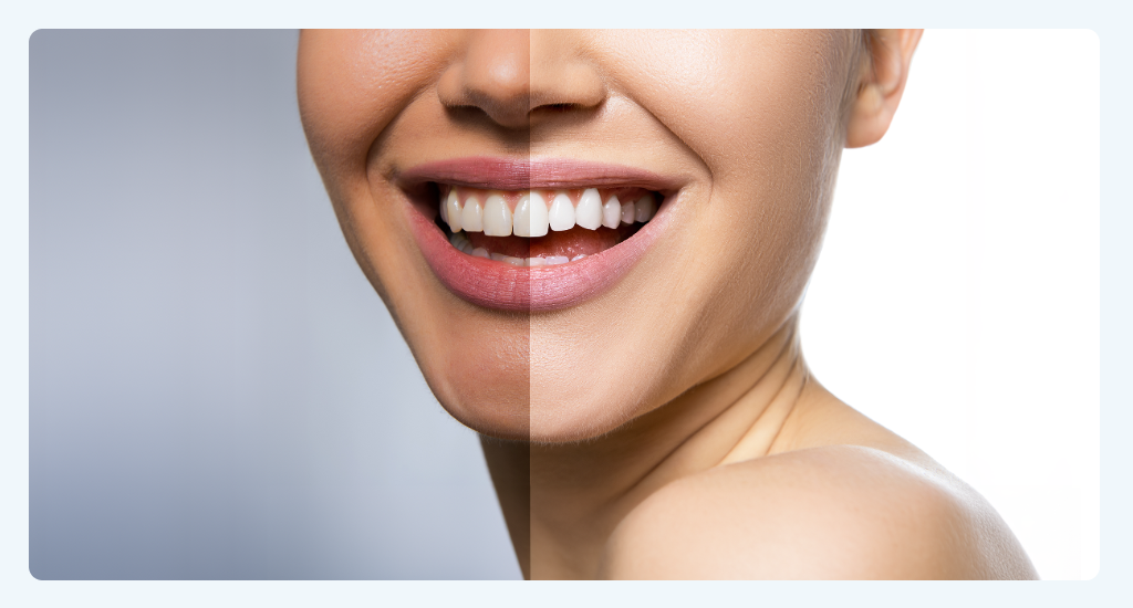 Close-up of a person showing a bright, white smile after teeth whitening